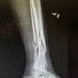 Broke leg