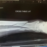 my broke leg